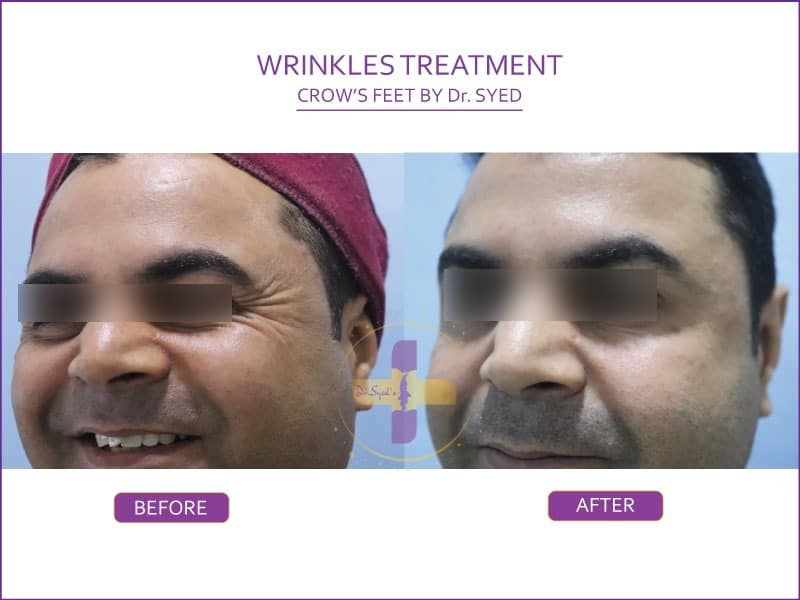 wrinkle-treatment-in-delhi