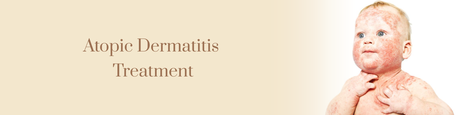 Atopic Dermatitis Treatment in Delhi