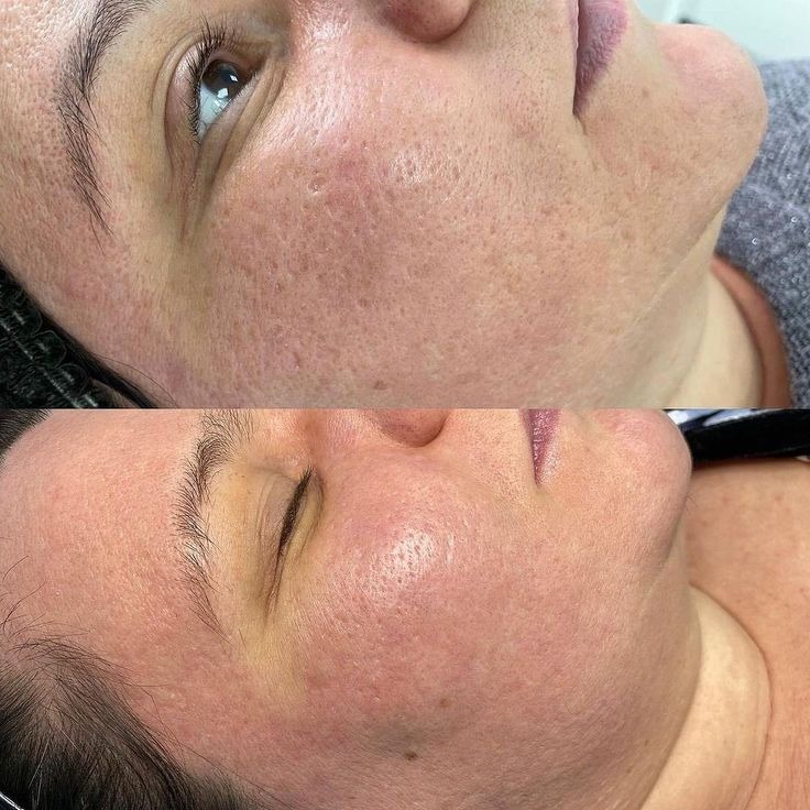 Acne Scar Treatment Before And After Done By Dr. Syed