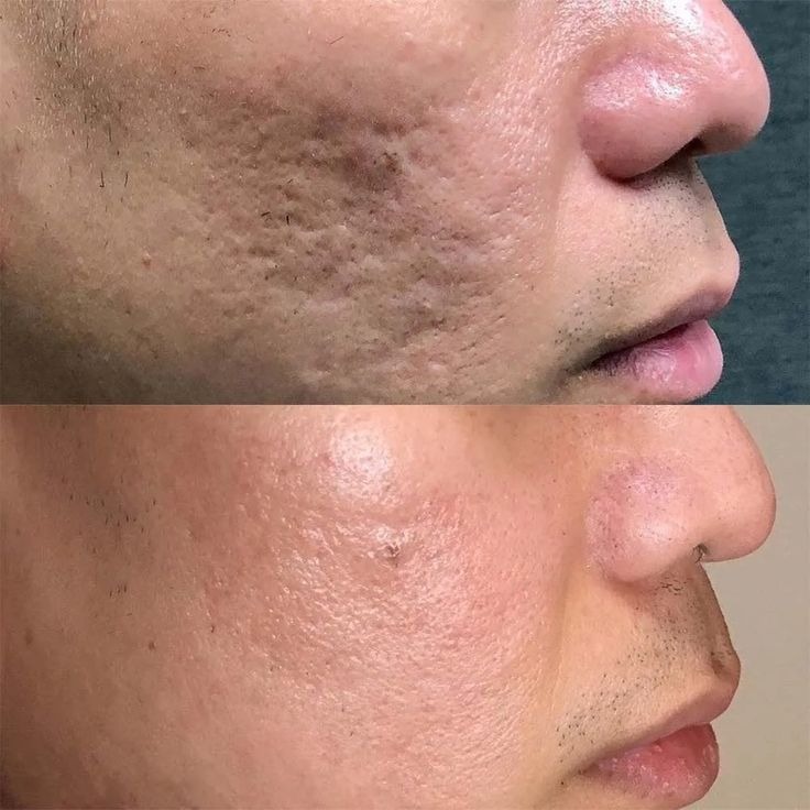 Acne Scar Treatment Before And After Done By Dr. Syed