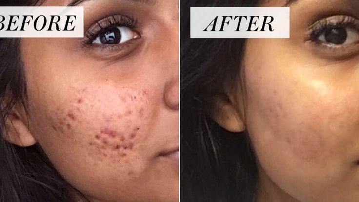 Pigmentation Treatment Before And After Done By Dr. Syed