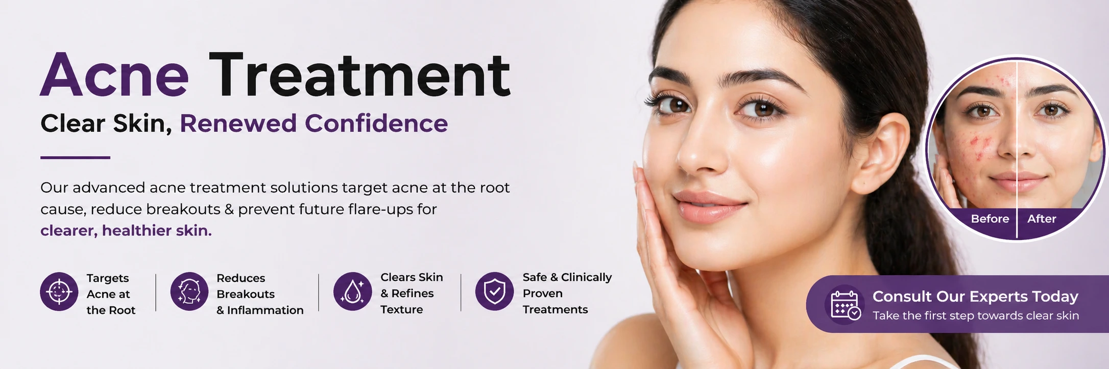 Acne Treatment in Delhi