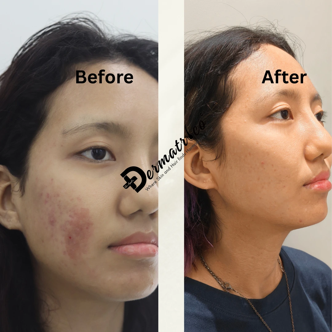 xanthelasma-treatment