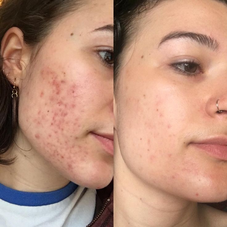 Pigmentation Treatment Before And After Done By Dr. Syed