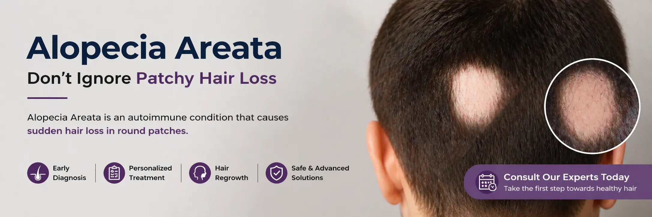 alopecia-areata Treatment in Delhi