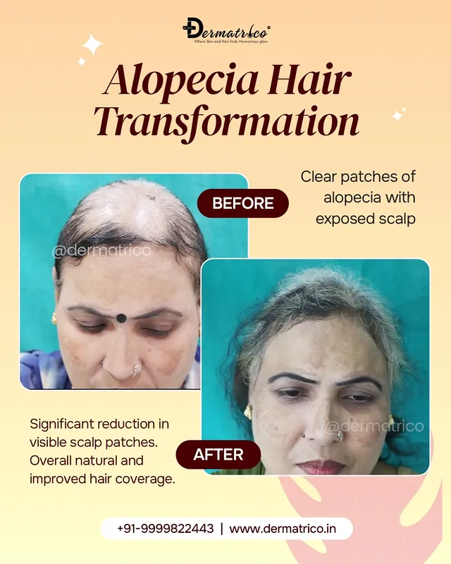 Lipoma Treatment Before And After Done By Dr. Syed