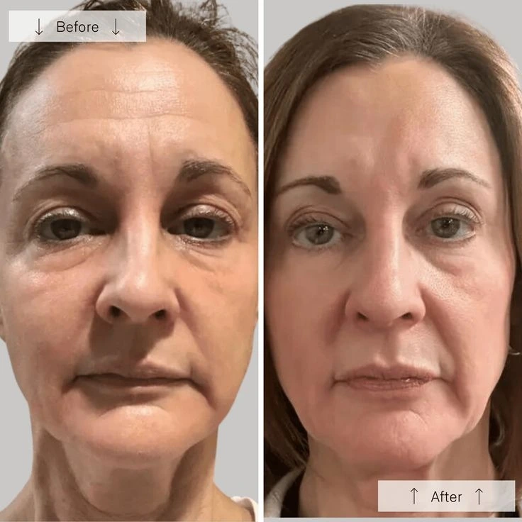 Anti Aging Treatment Before And After Done By Dr. Syed