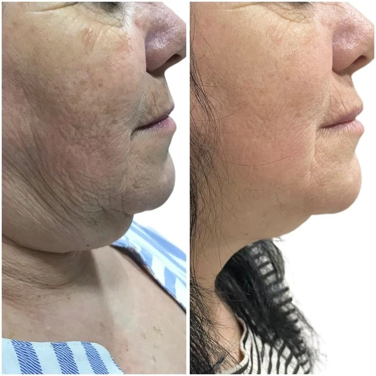 Anti Aging Treatment Before And After Done By Dr. Syed
