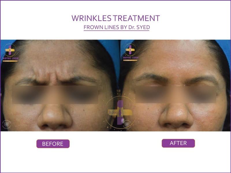 anti-wrinkle-treatment-delhi