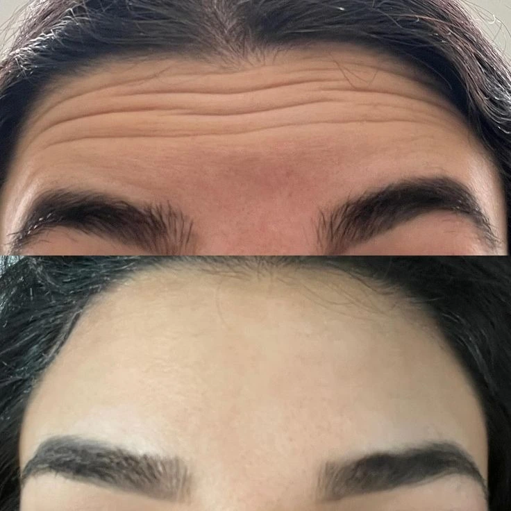 Best Anti Wrinkle Treatment Before And After Done By Dr. Syed