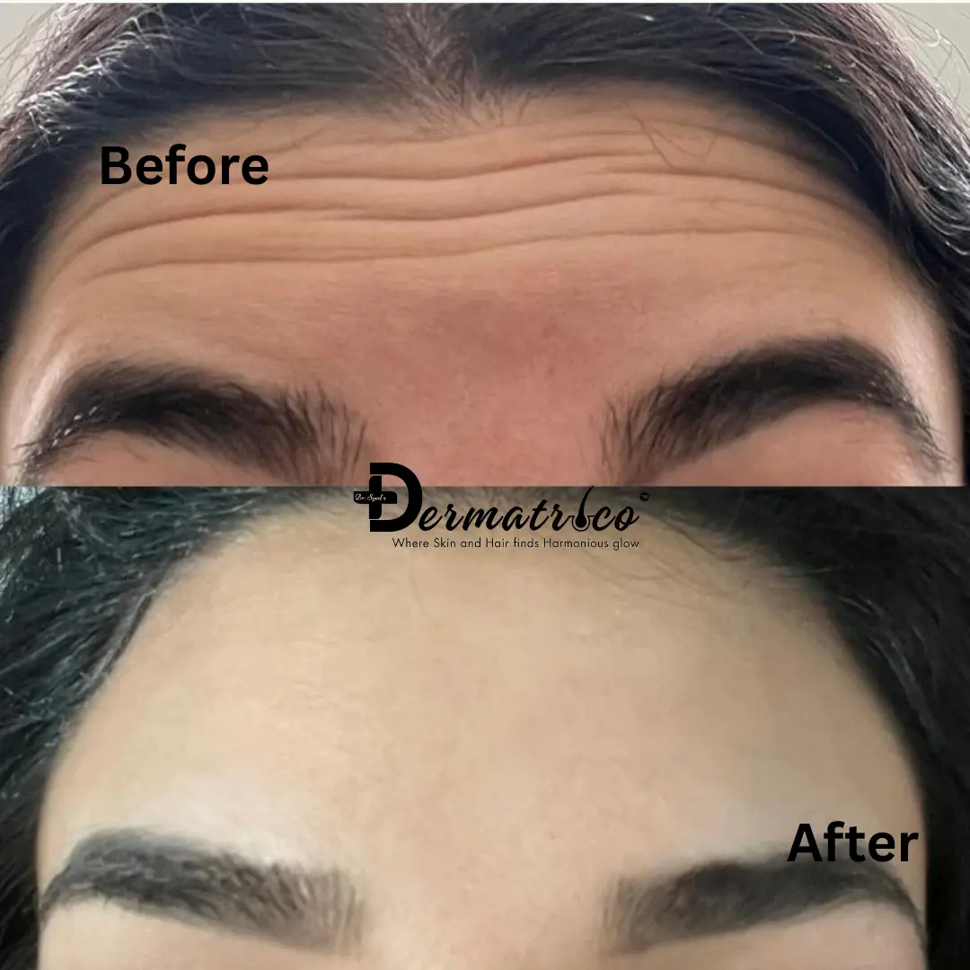 Anti Wrinkle Treatment Before And After Done By Dr. Syed