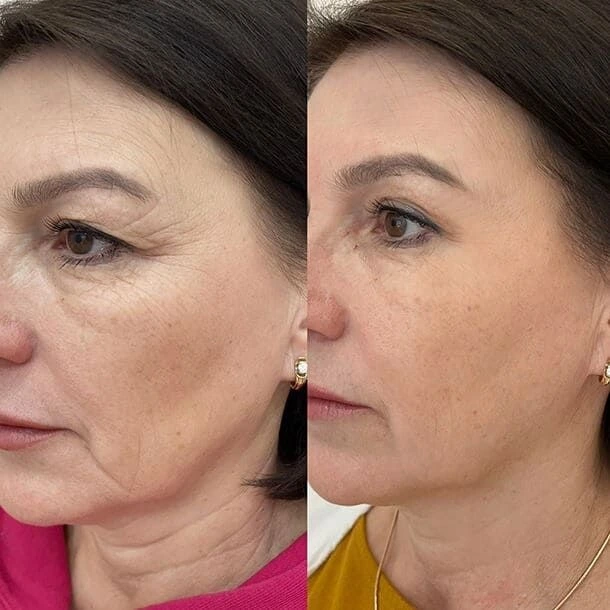 Anti Wrinkle Treatment Before And After Done By Dr. Syed
