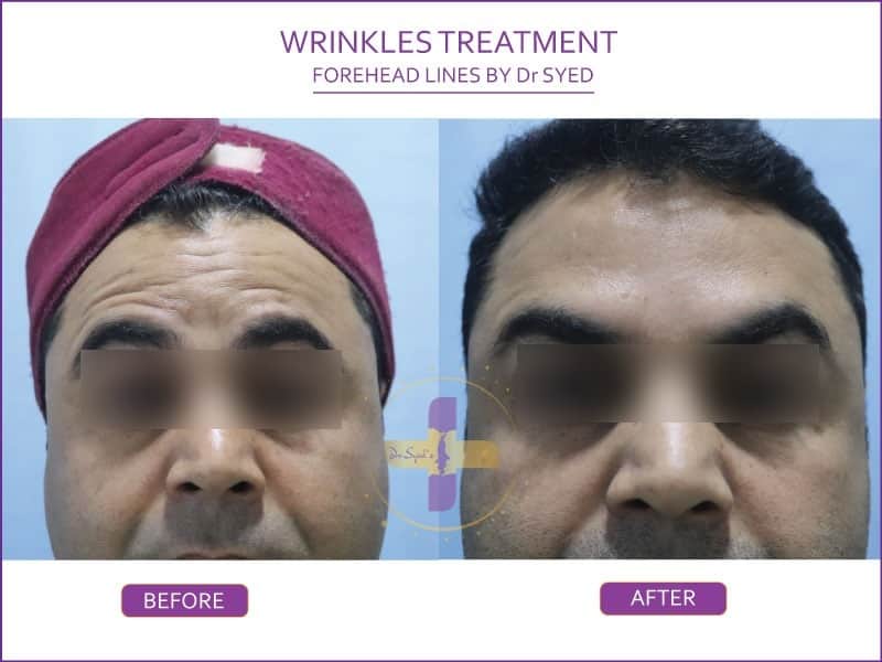 best-wrinkle-treatment-delhi