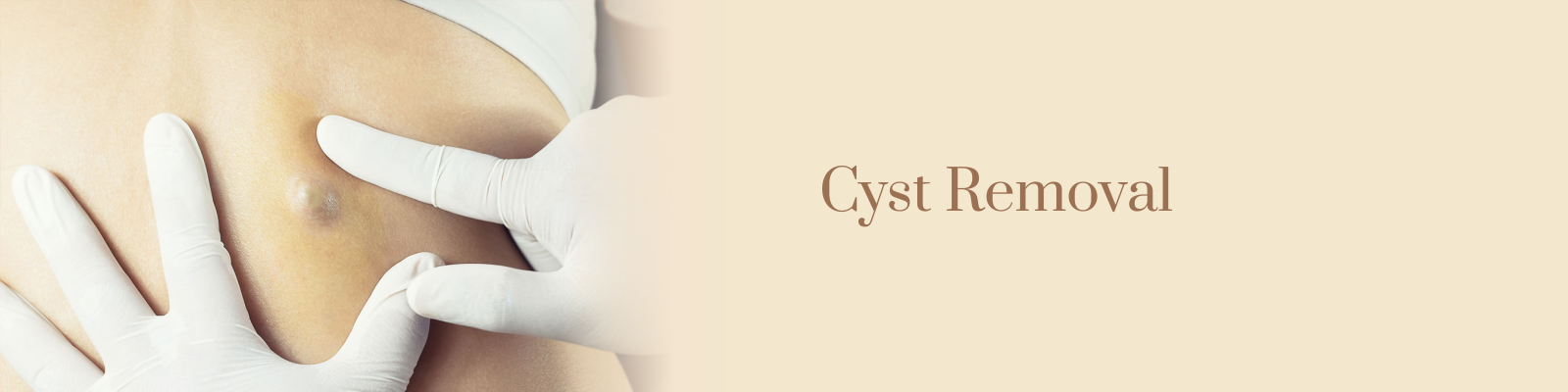 Cyst Removal Treatment in Delhi