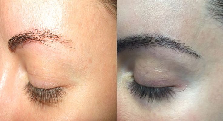 Eye Brow Treatment Before And After Done By Dr. Syed