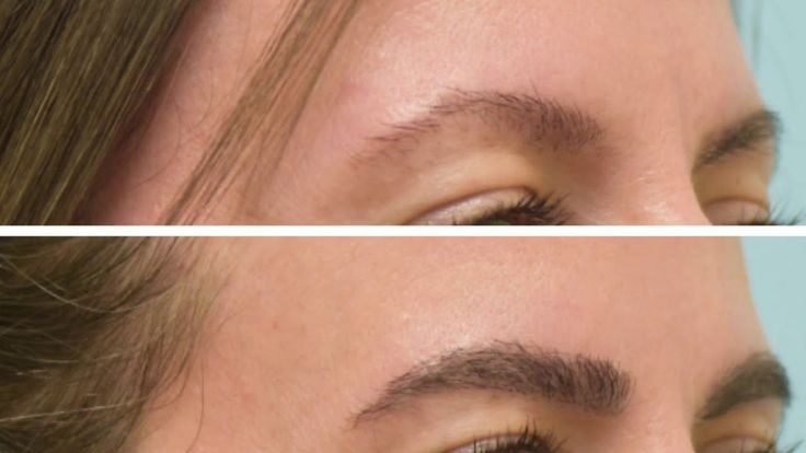 Eye Brow Treatment Before And After Done By Dr. Syed