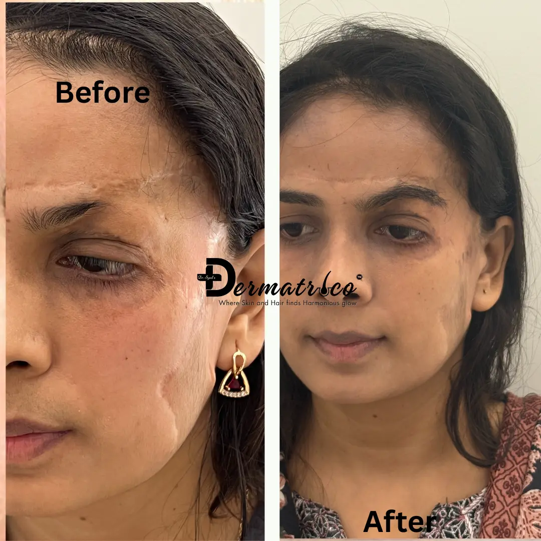 Eye Brow Treatment Before And After Done By Dr. Syed