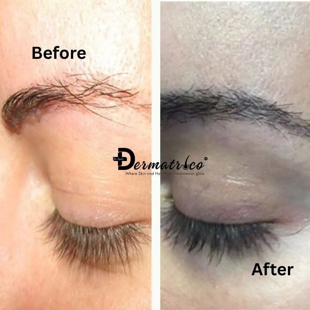 Eye Brow Treatment Before And After Done By Dr. Syed