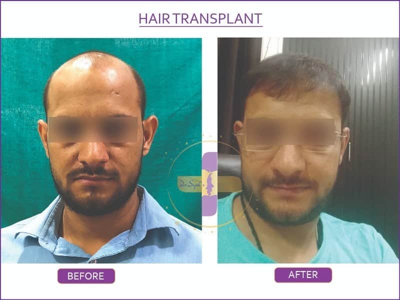 best-hair-transplant-cost-in-delhi