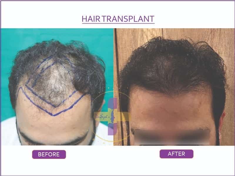 best-hair-transplant-cost-in-india