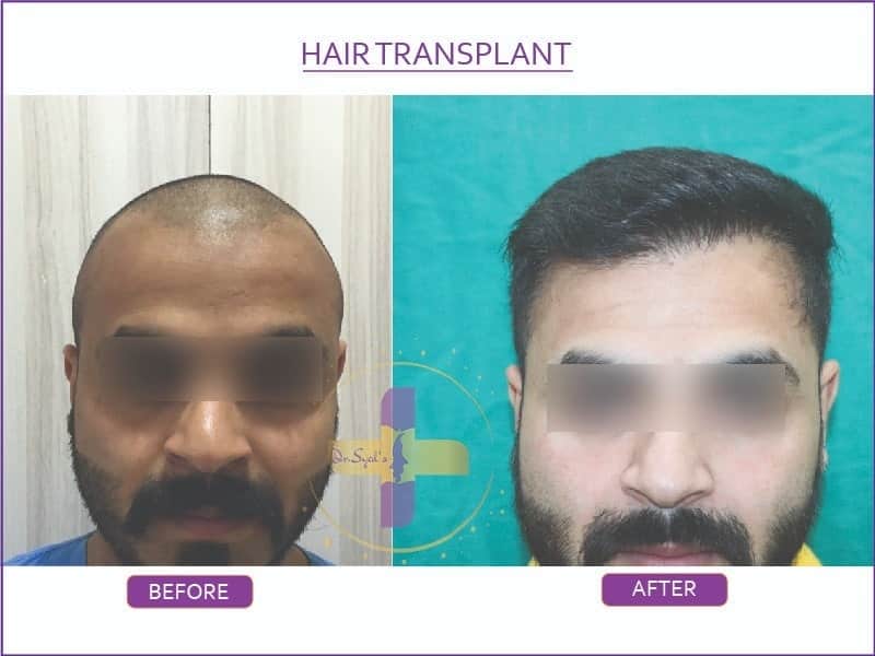 best-hair-transplant-in-delhi