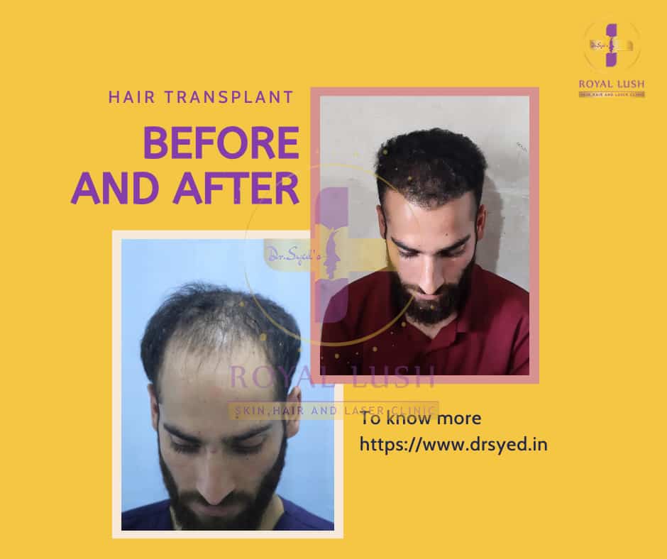 best-hair-transplant-in-india