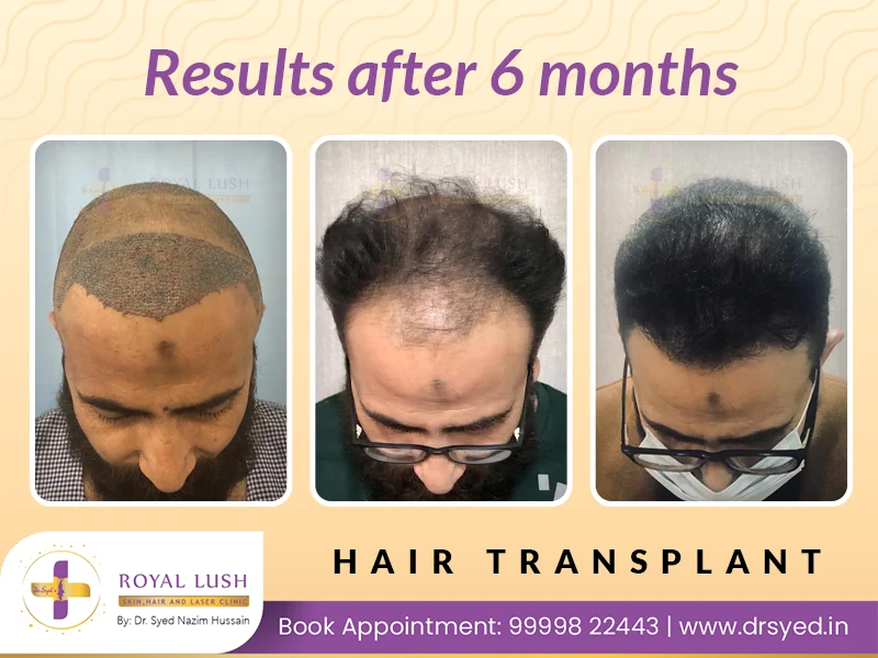 best-hair-transplant-cost-in-delhi