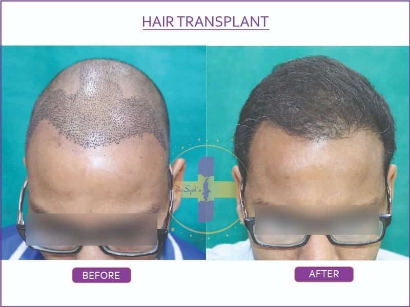 hair-transplant-cost-in-delhi