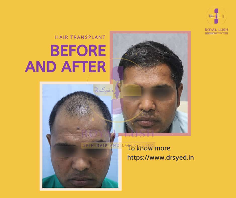 hair-transplant-cost-in-india