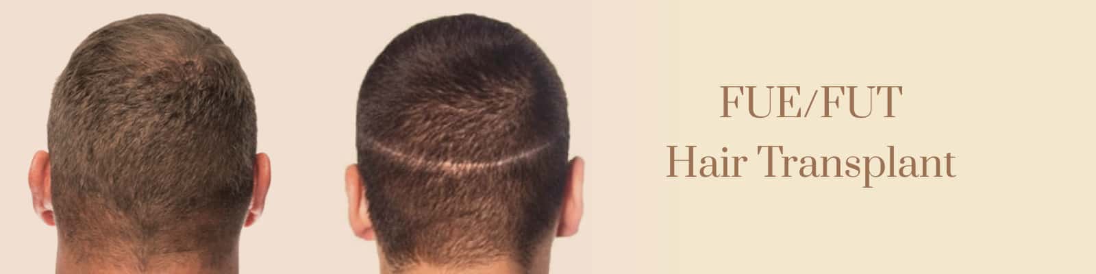 Best hair transplant clinic in pune  hair transplant results  Hair  transplant Best hair transplant Hair transplant results