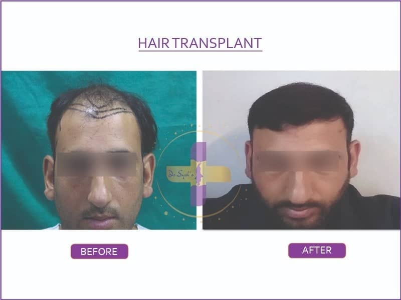 hair-transplant-in-india