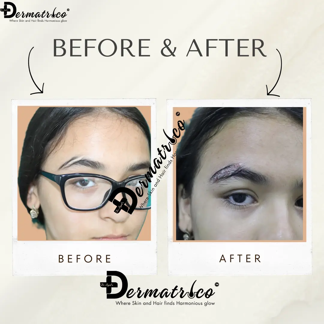 Hair Transplant Result