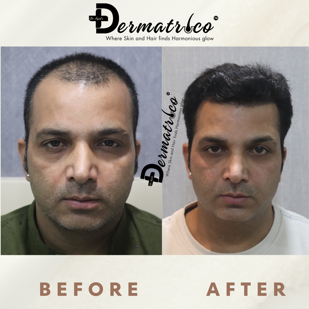 Hair Transplant Result