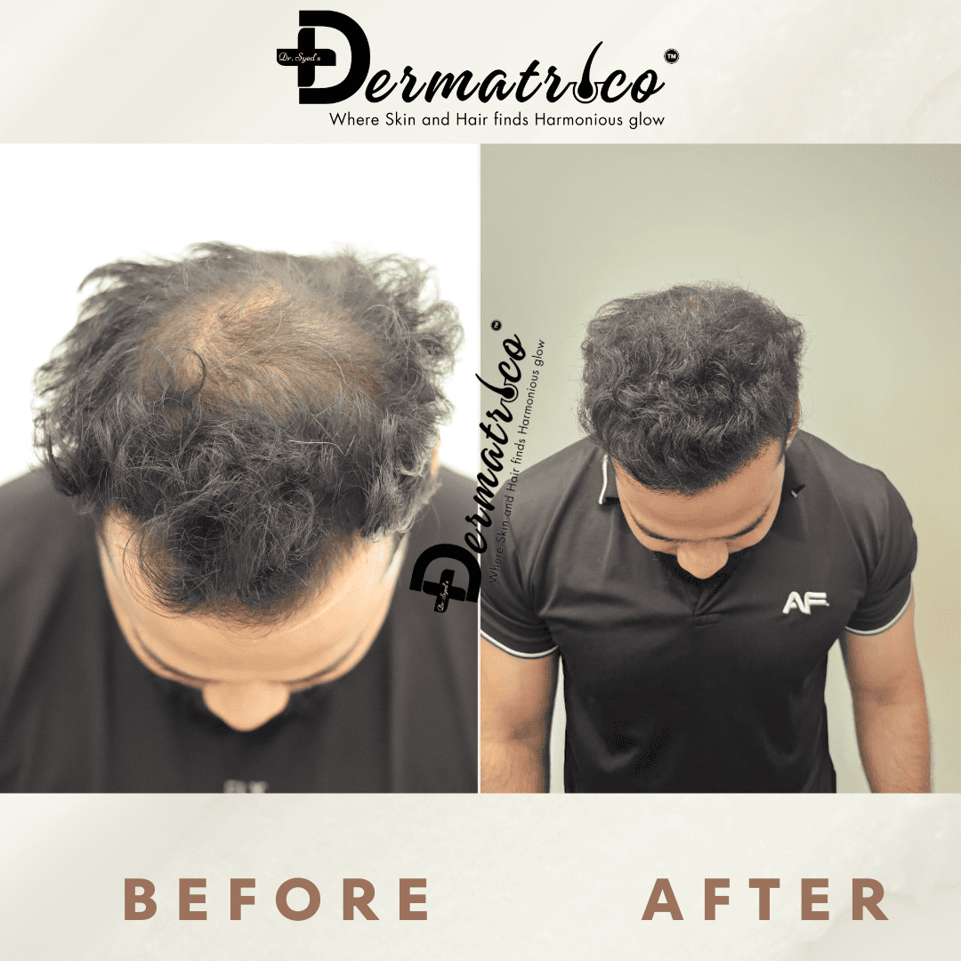 Hair Transplant Result