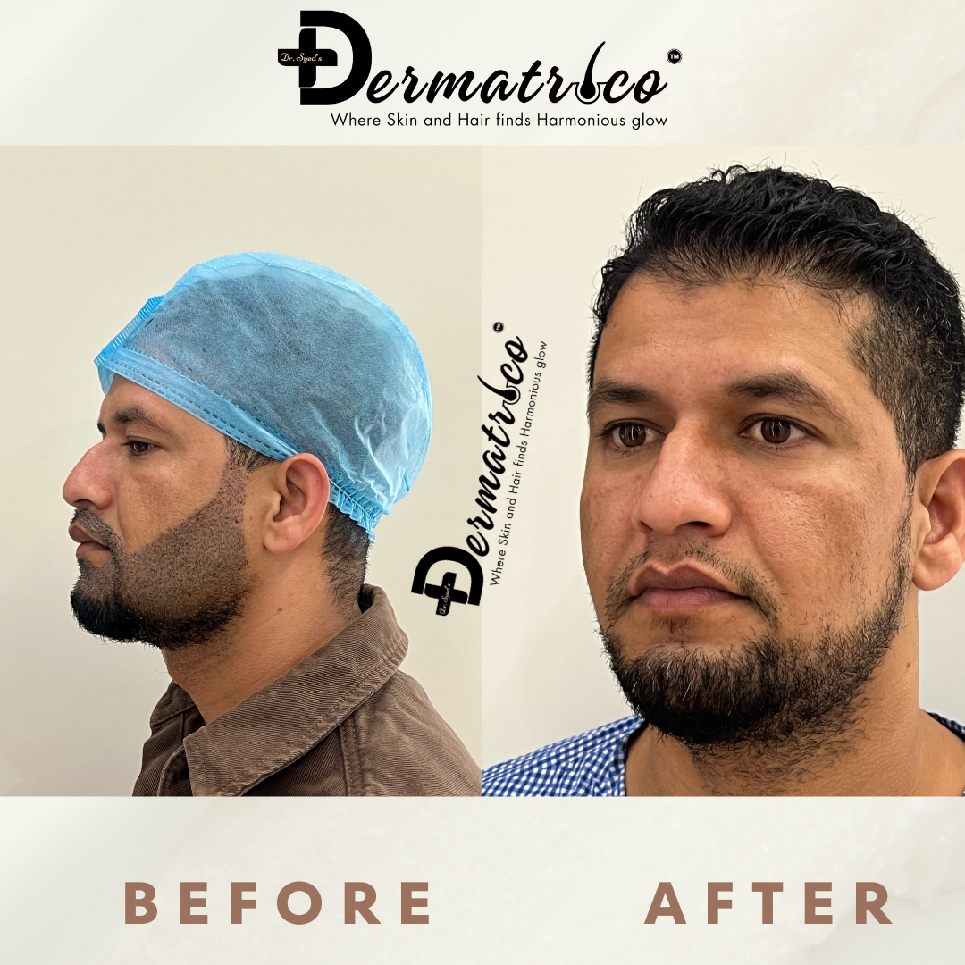 Beard Transplant