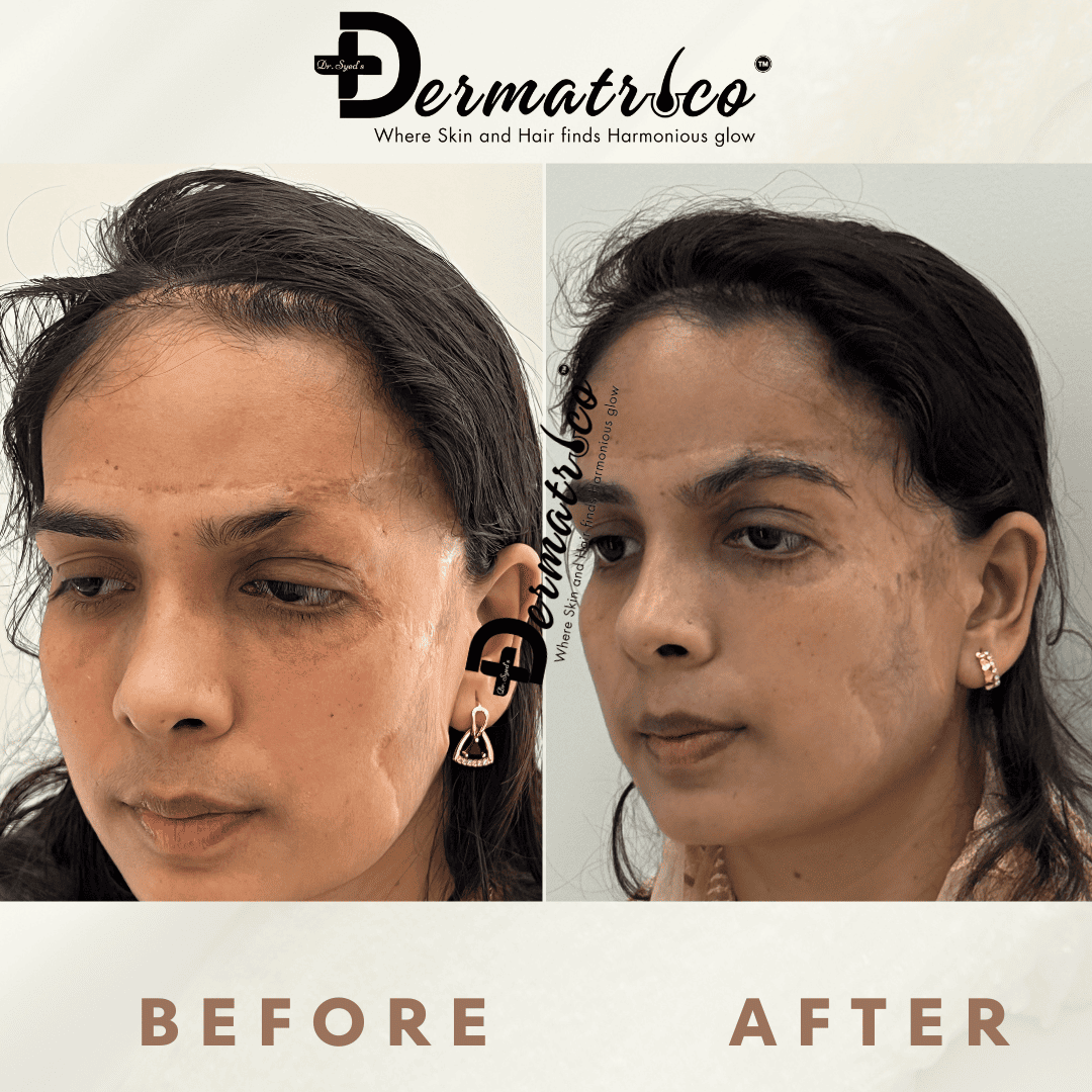 Hair Transplant Result