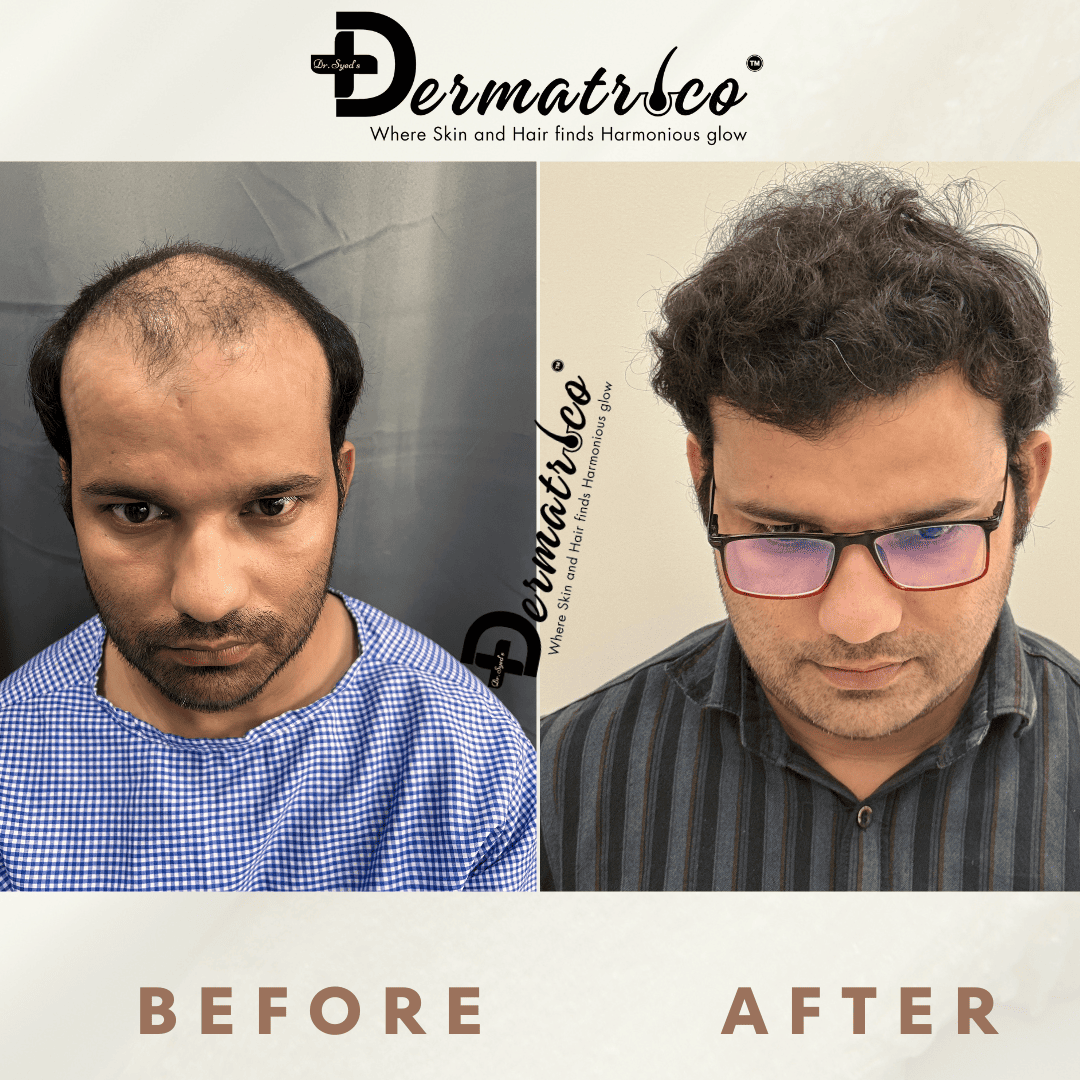 Hair Transplant Result