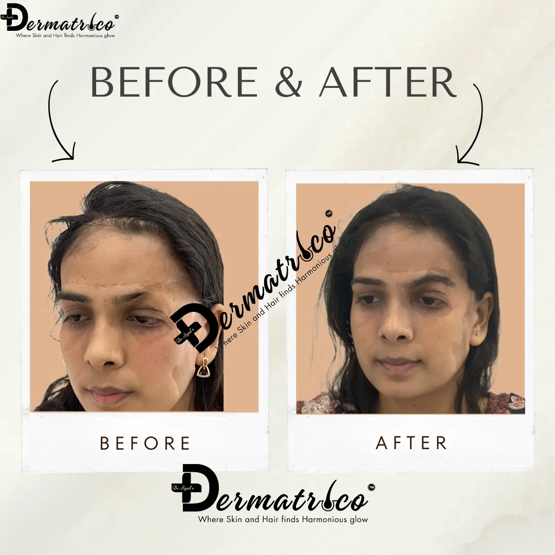 Hair Transplant Result