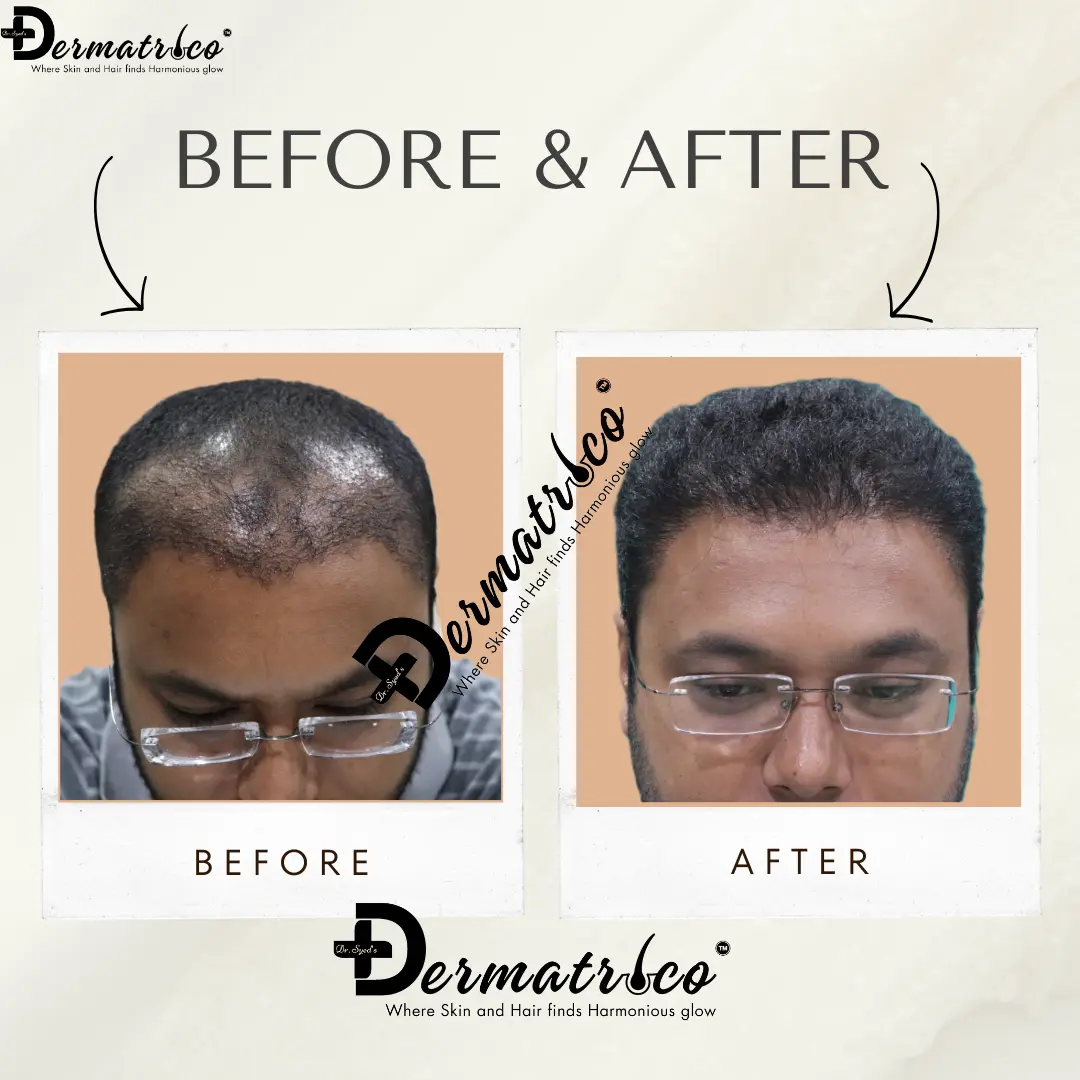Hair Transplant Result