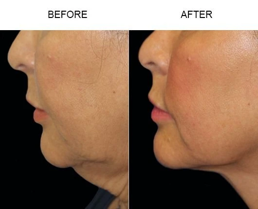 Pigmentation Treatment Before And After Done By Dr. Syed