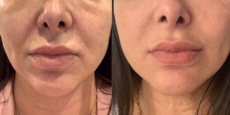 Pigmentation Treatment Before And After Done By Dr. Syed