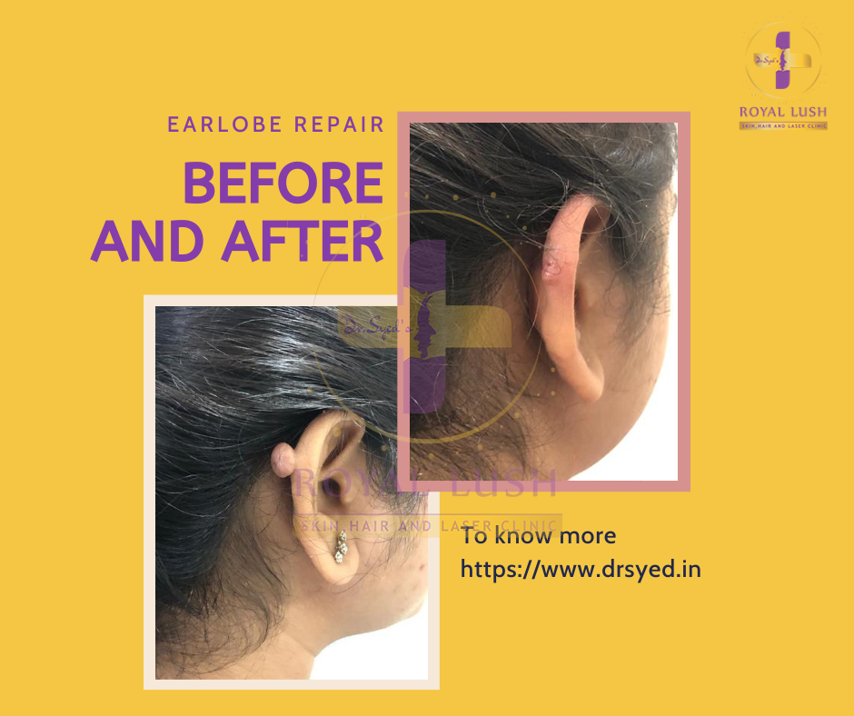 keloids removal treatment in south delhi