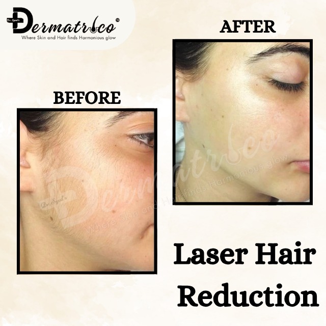 laser-hair-reduction