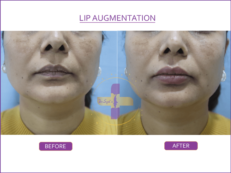 lip augmentation in Saket
