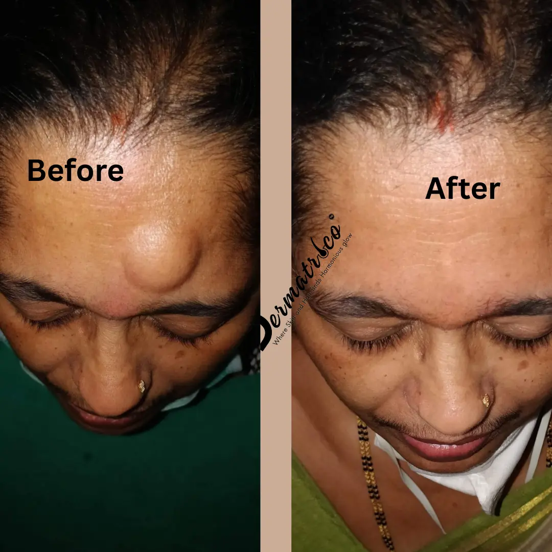 Lipoma Treatment Before And After Done By Dr. Syed