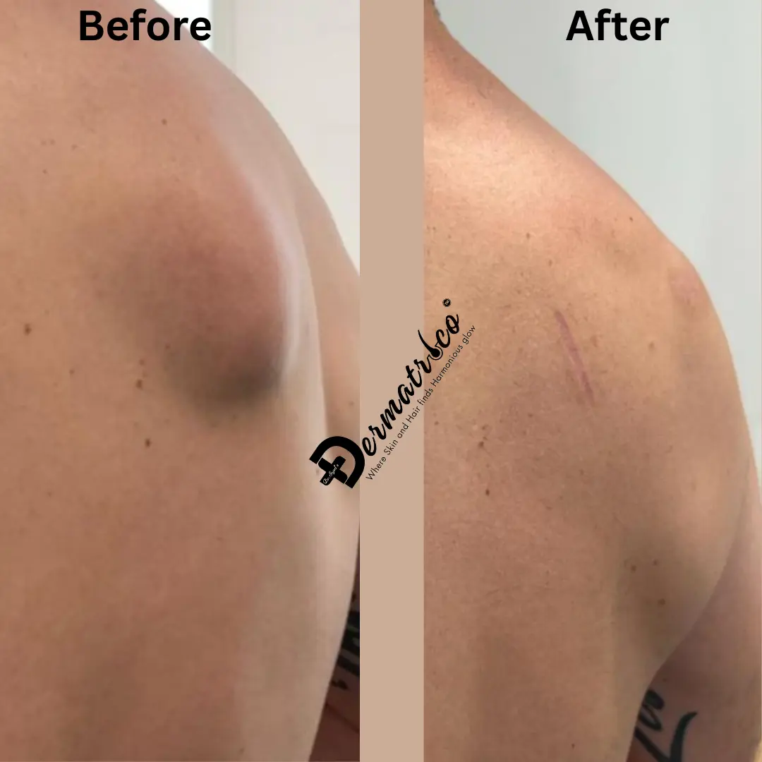 Lipoma Treatment Before And After Done By Dr. Syed