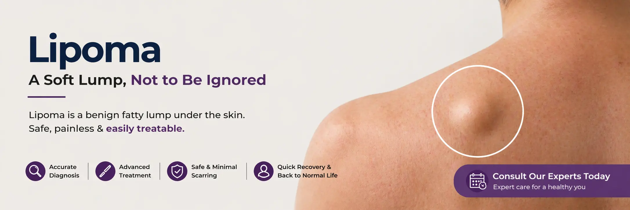 Lipoma Treatment in Delhi