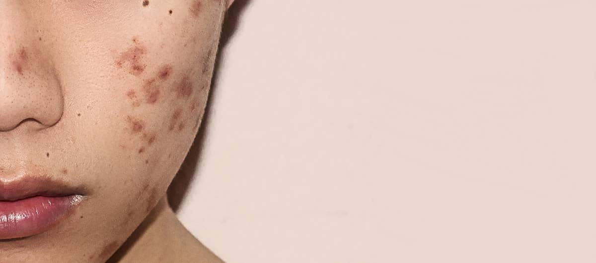 best-pigmentation-treatment-delhi6