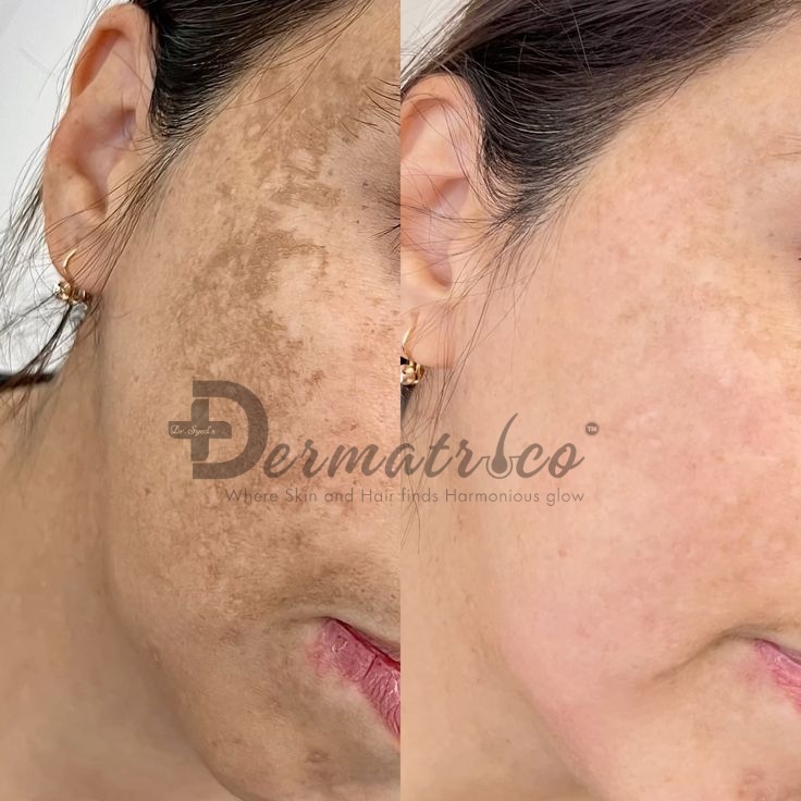 best-pigmentation-treatment-in-india