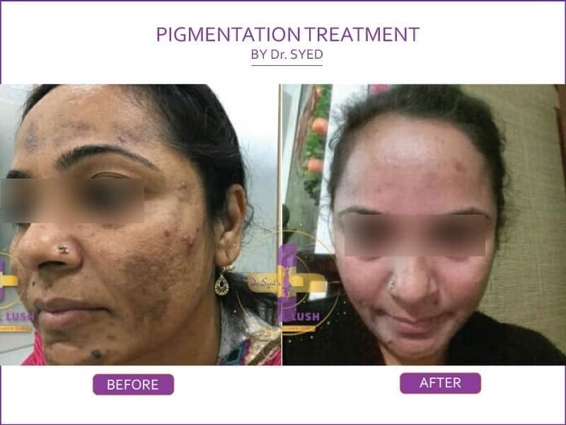 best-pigmentation-treatment-in-india